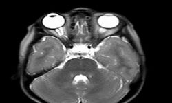 Optik gliom nedir?