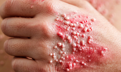 50 yaş üstüne zona uyarısı: Çocuklukta geçirilen suçiçeği yıllar sonra geri dönebilir