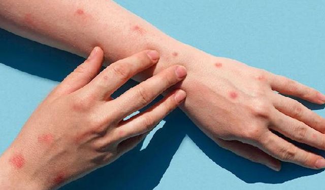 Maymun Çiçeği Virüsü: Nedir, Nasıl Bulaşır, Belirtileri Nelerdir?