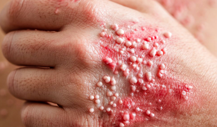 50 yaş üstüne zona uyarısı: Çocuklukta geçirilen suçiçeği yıllar sonra geri dönebilir