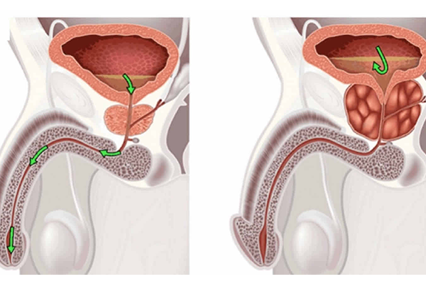 Prostat belirtileri nelerdir? Prostat büyümesi ve prostat kanseri hakkında bilinmesi gerekenler